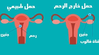 الحمل خارج الرحم د.ابراهيم ابوحارس لعلاج امراض النساء والتوليد