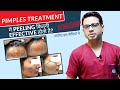 How Peeling treat Acne/Pimples & Scars? | Acne scar treatment in Delhi | Skinqure