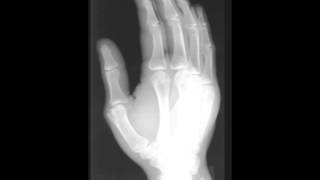 Normal x ray hand except soft tissue swelling screenshot 5