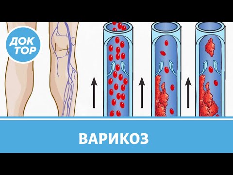 Проведение склеротерапии при варикозе. Вопросы флебологу