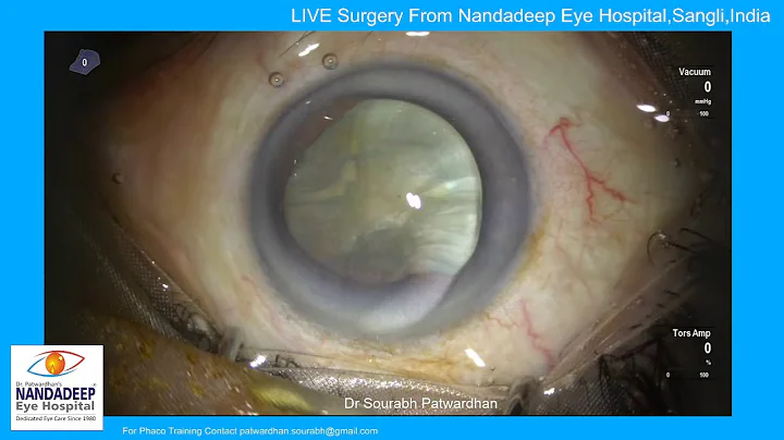 Live Surgery  Magnificent IOL by caregroup Sourabh...