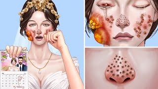 ASMR Big Acne & Maggot Infested Face Removal | Severely Injured Animation