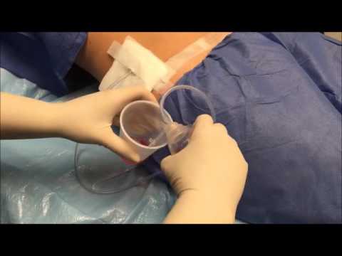 How to Maintain Your Jackson Pratt Drain after Surgery (JP Drain)
