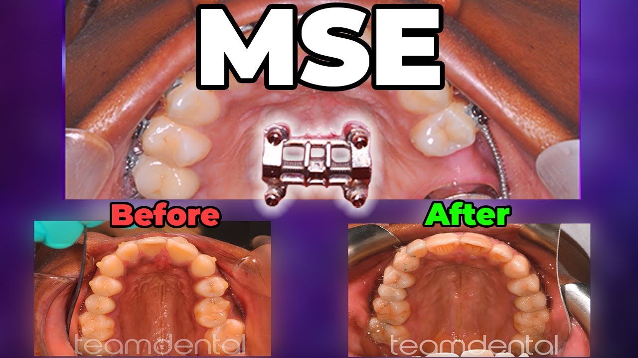 What is MSE? - Maxillary Skeletal Expander - Dr. Kennedy