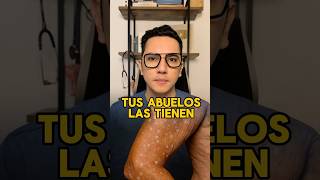 Tus abuelos y papás tienen estas pequeñas manchas en los brazos (hipomelanosis guttata idiopática).