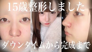 15歳整形しました ダウンタイムから完成まで 目尻切開 目頭切開 小鼻縮小 Youtube 15歳整形しました ダウンタイムから完成まで 目尻切開 目頭切開 小鼻縮小 Youtube