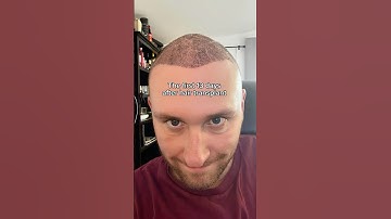 Hair Transplant Journey: 13 Days of SHOCKING Changes!