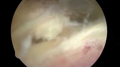 Shoulder Artrhoscopy Dr. Cascio: Suprascapular nerve release 2 of 2