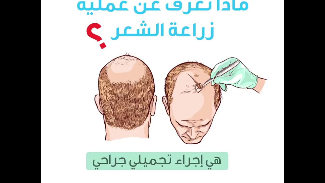 زراعة الشعر - ويب طب