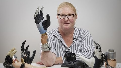 ‘Groundbreaking’ bionic arm that fuses with user’s skeleton and nerves could advance amputee care