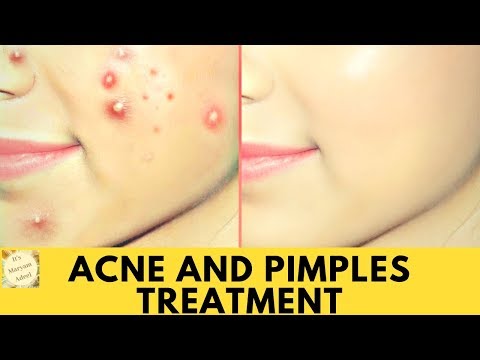 Pimples and acne treatment permanently at home |Maryam Adeel | چہرے کے داغ دانے پیمپلز کا مستقل علاج