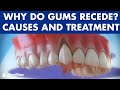 Gum recession - Treatment of gingival retraction ©