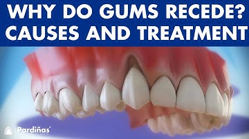 Gum recession - Treatment of gingival retraction ©