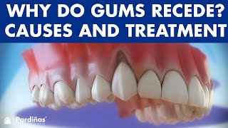 Gum recession  Treatment of gingival retraction ©