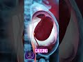 How Kidney Stones Block Urine Flow