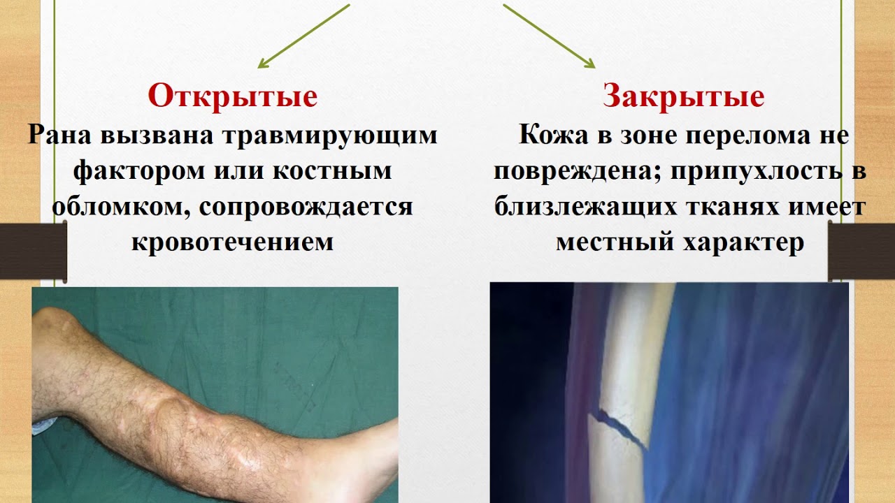 Оказания первой медицинской помощи при ушибах и переломах ОБЖ 7 класс