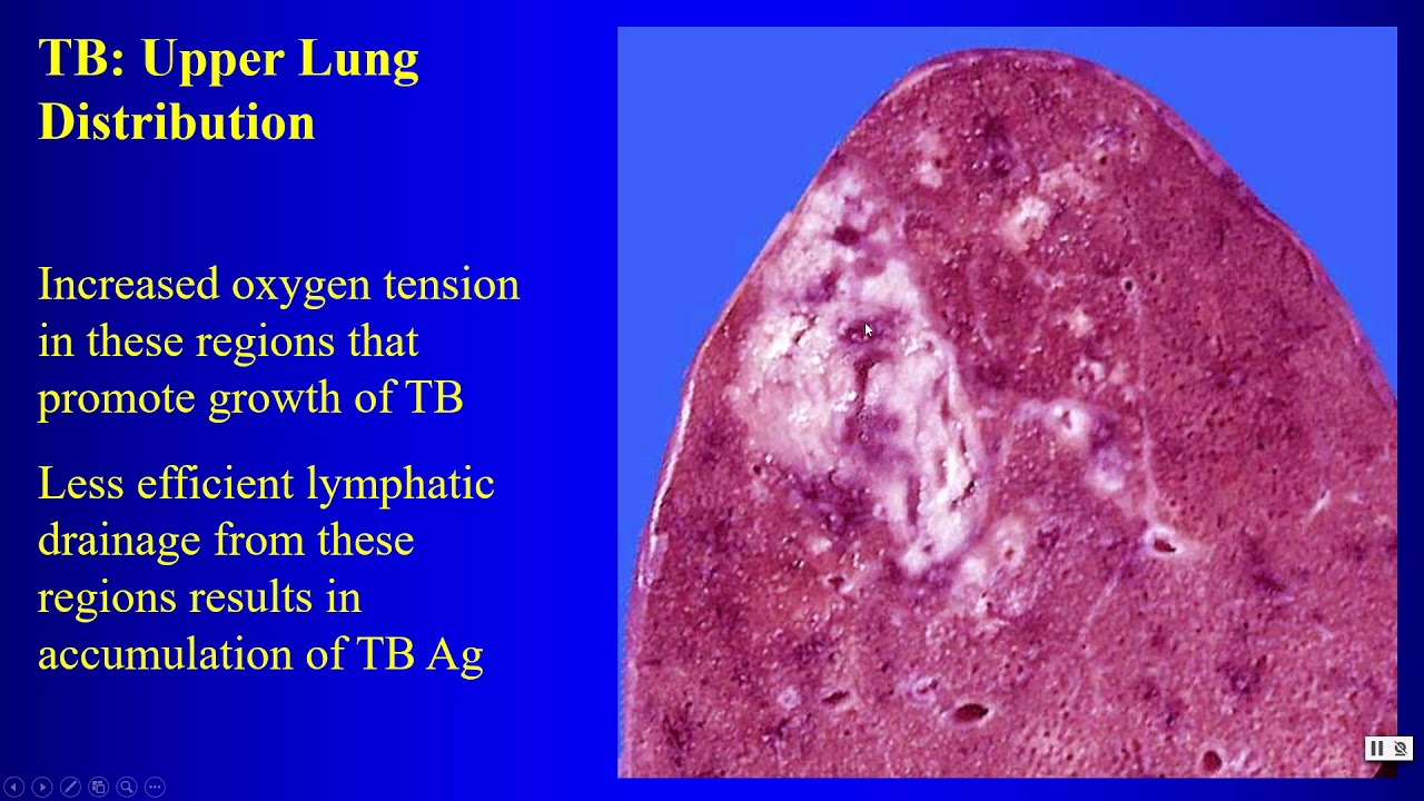 14a ILD P1 Upper lung ILD