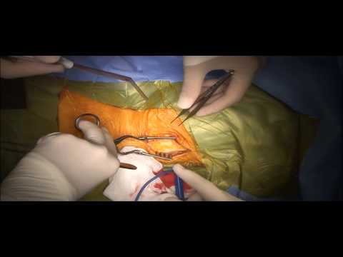 Karotid Arter (Şah Damarı) Ameliyatı