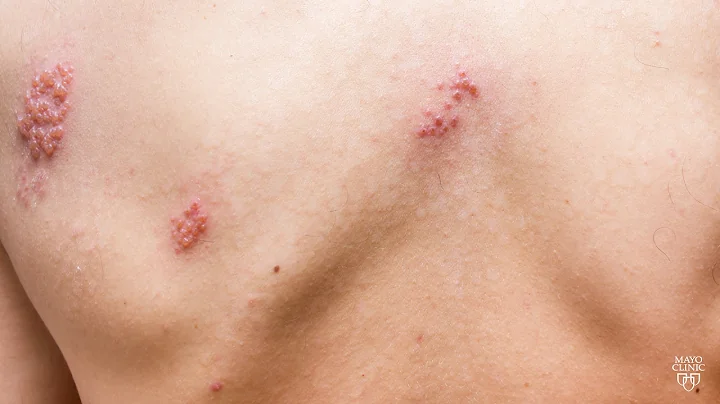 Mayo Clinic Minute: Don't suffer with shingles - DayDayNews