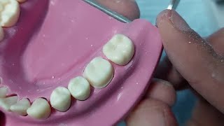 ازاى تعمل Reduction بسهوله _full metal crown preparation for lower 6 #Dr_ghazal