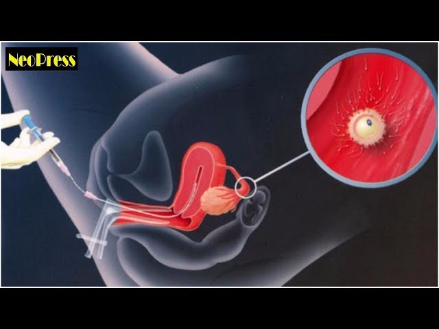 邦楽 GLANEY TAKE the TRIPP/A Test Tube Baby IVF- Test Tube