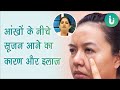 आ ख क न च स जन क क रण इल ज और दव Aankhon Ke Neeche Sujan Hone Ka Karan Ilaj Dawa In Hindi