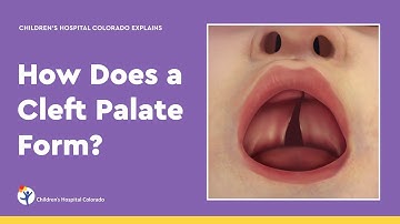 How Does a Cleft Palate Form?