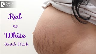 Dark stretch marks & Light stretch marks. Causes & Treatment - Dr. Rasya Dixit | Doctors