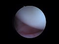 R Rotator Cuff Repair with Arthrex Fibertak and biceps tenodesis 8 22 22 FA