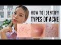 How to treat EVERY type of acne (With Pictures )