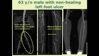 Noninvasive Assessment of CLI (US, CTA, MRA) - Constantino Pena, MD