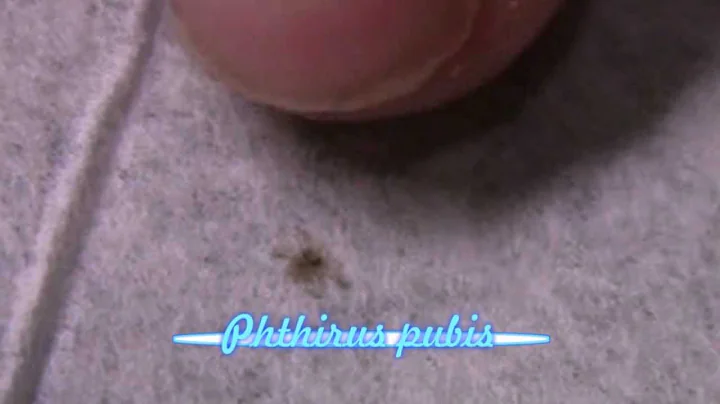 Pubic Lice--Live in the ER - DayDayNews