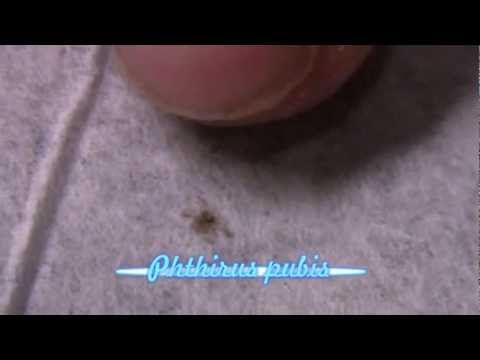 Pubic Lice--Live in the ER