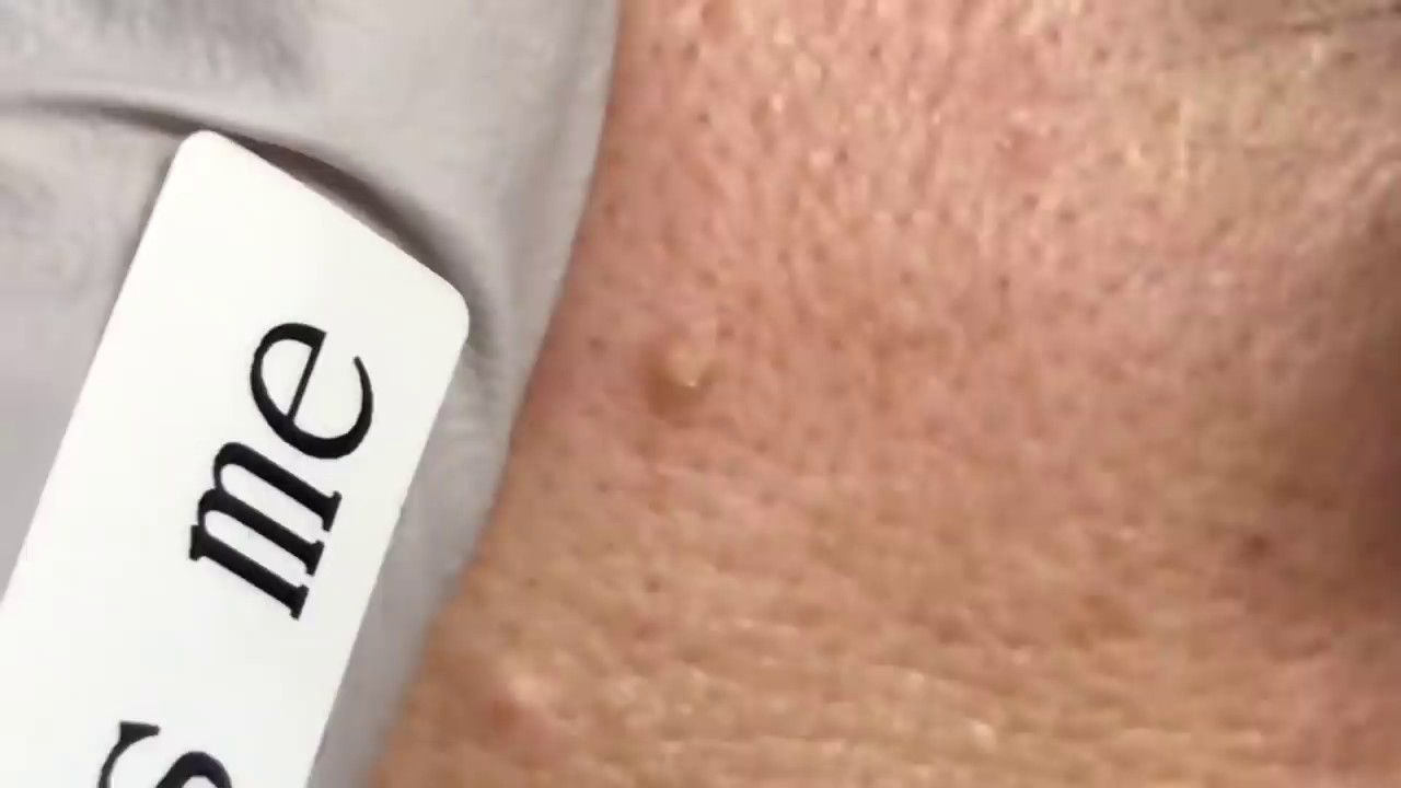 is medical abbreviation Milia