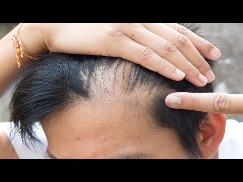 How I Got My Hair Back (Male Pattern Baldness and Females) hair grow back after thinning