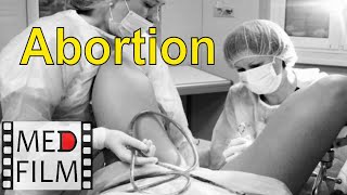 (Англ.) Аборт Методом Вакуум-Экскохлеации © Abortion By Vacuum Excretion