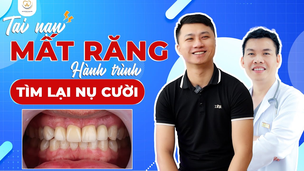 Tai Nạn Mất Răng Và Hành Trình Tìm Lại Nụ Cười Của Anh Hưng | Bác sĩ ...