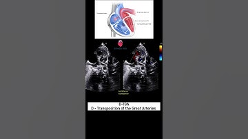 D-Transposition of the Great Arteries (D-TGA) | 2D Echo #DTransposition #DTGA #congenital