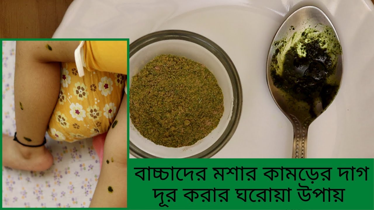 Mosquito bite marks removal home remedies for kids বাচ্চাদের মশার কামড়ের দাগ দূর করার ঘরোয়া