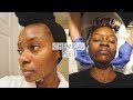 CHEMICAL PEEL FULL PROCESS! | Remove Dark Marks Acne Scars and Acne with Chemical Peel