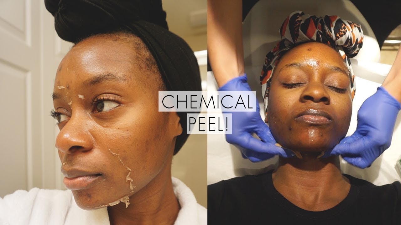 I Tried A Chemical Peel! | Full Process, Before And After Dark Marks & Acne  Scars - Youtube