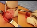 Herniotomy in pediatric