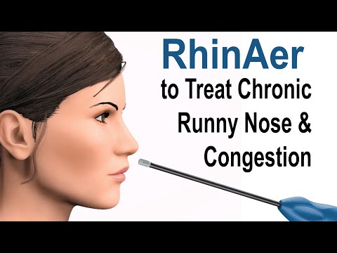 RhinAer to Treat Chronic Runny Nose and Congestion