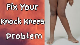 12 Exercises To Fix Your Knock Knee | How To Fix Your Knock Knees | Knock Knees को कैसे ठीक करें