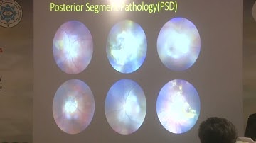 AIOC2024   Free Paper   Community II  FP685  Upcycled Smartphones for Screening Posterior Segment Di