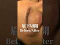 ナチュラルに変化できるのが良いところ🌟#眉下リフト #眉下切開 #整形