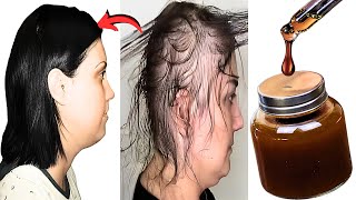 Get Faster Hair Growth In Just 1 Week! | The Best Hair Mask For Hair Growth And Damaged Hair