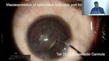 AIOCMTC4 2025 GP7 T Dr Harshul Tak Tak Viscoelastic and Hydrostitch cannulas   Tips and Tricks