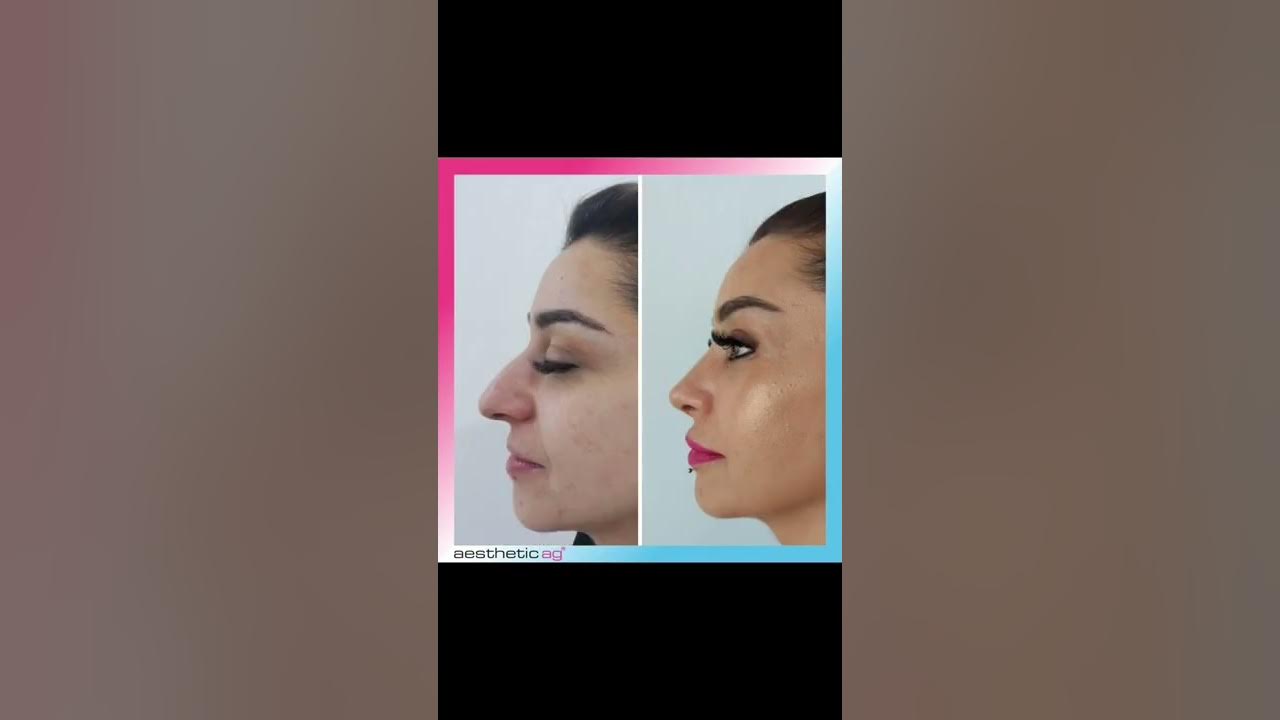 Nasenkorrektur Nasen op in der Türkei YouTube