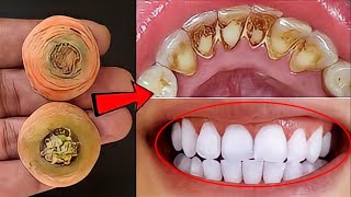 تبييض الاسنان بالمنزل في 3 دقائق || كيف تبيض أسنانك الصفراء بشكل طبيعي || فعالية 100٪